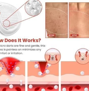 Skin Tag Remover Patch 50% Off